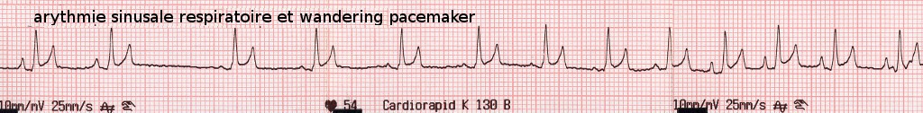 Le wandering pacemaker est fréquent chez le chien