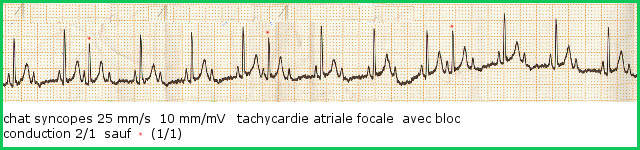 Bloc atrioventriculaire fonctionnel au cours d'une TAF (tachycardie atriale focale)