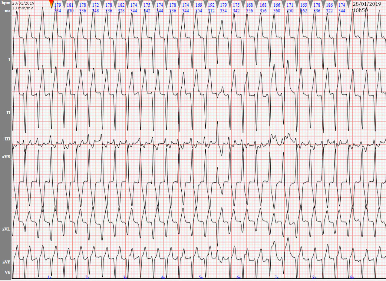 Tachycardie ventriculaire succédant à une fibrillation atriale