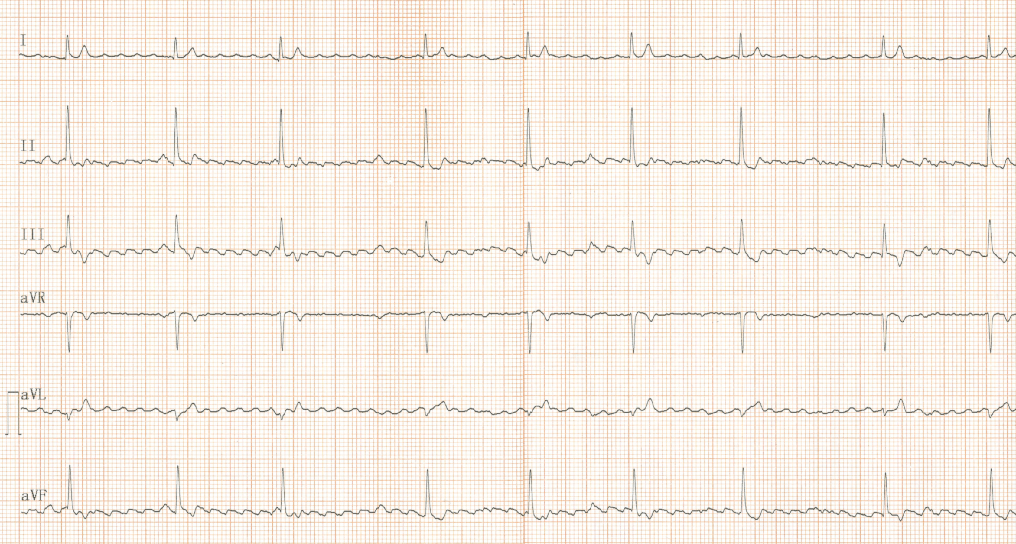 Flutter atrial avec conduction auriculo-ventriculaire variable.