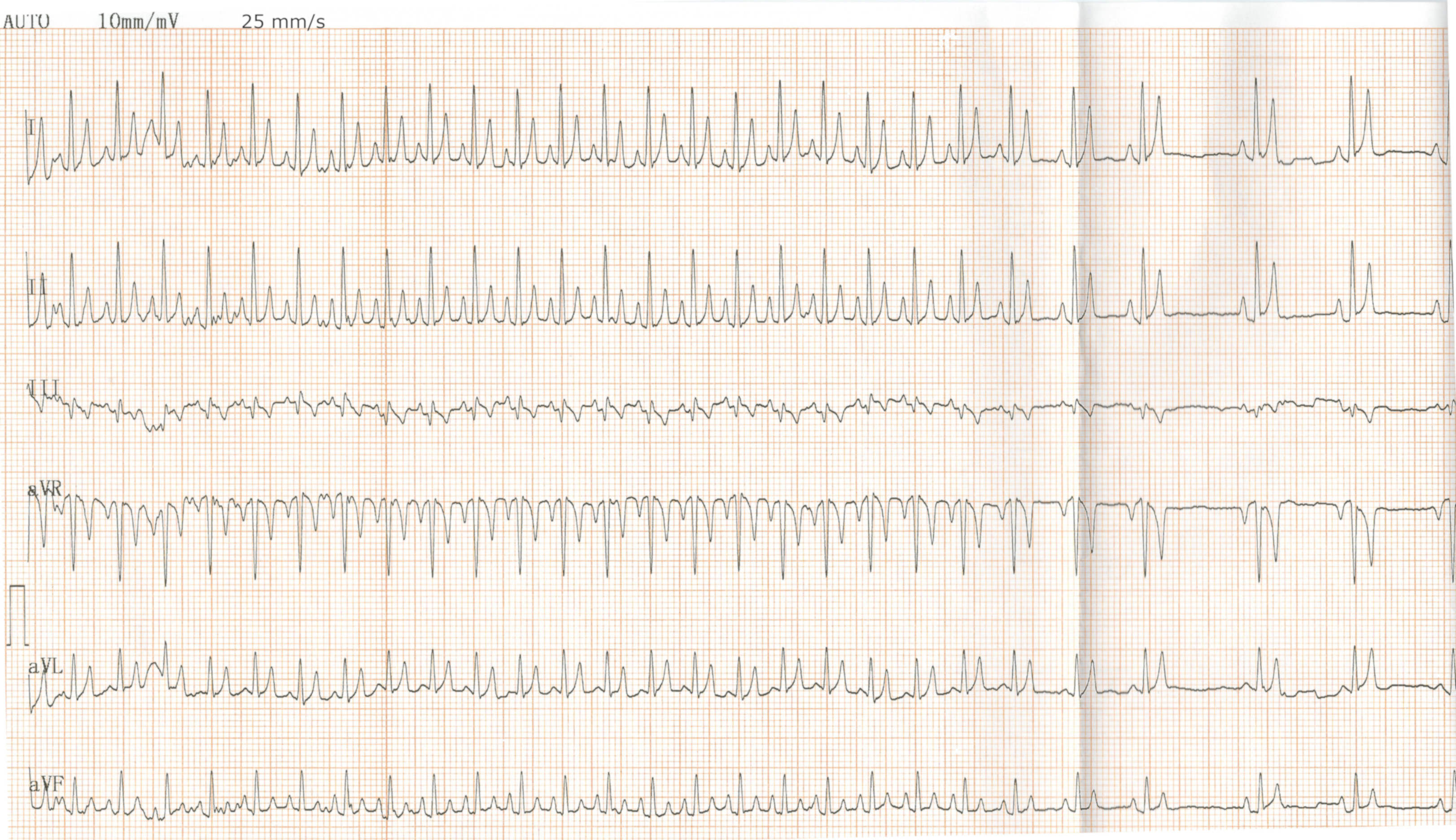 Tachycardie atriale ectopique (tachycardie atriale focale avec conduction AV 1:1