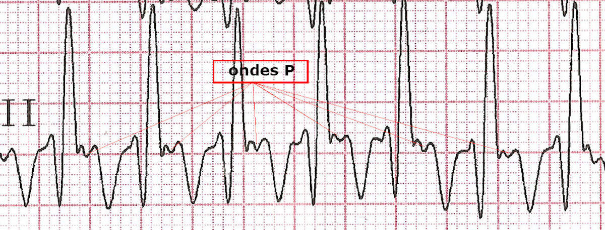 Ondes P rétrogrades dans une tachycardie jonctionnelle