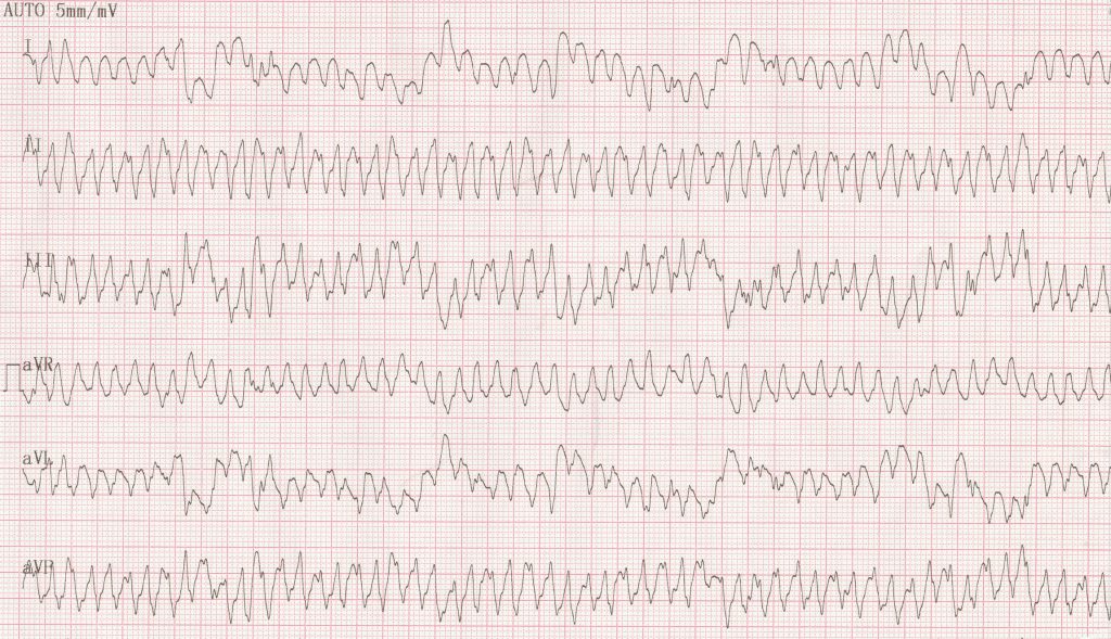 Tachycardie très rapide à QRS larges