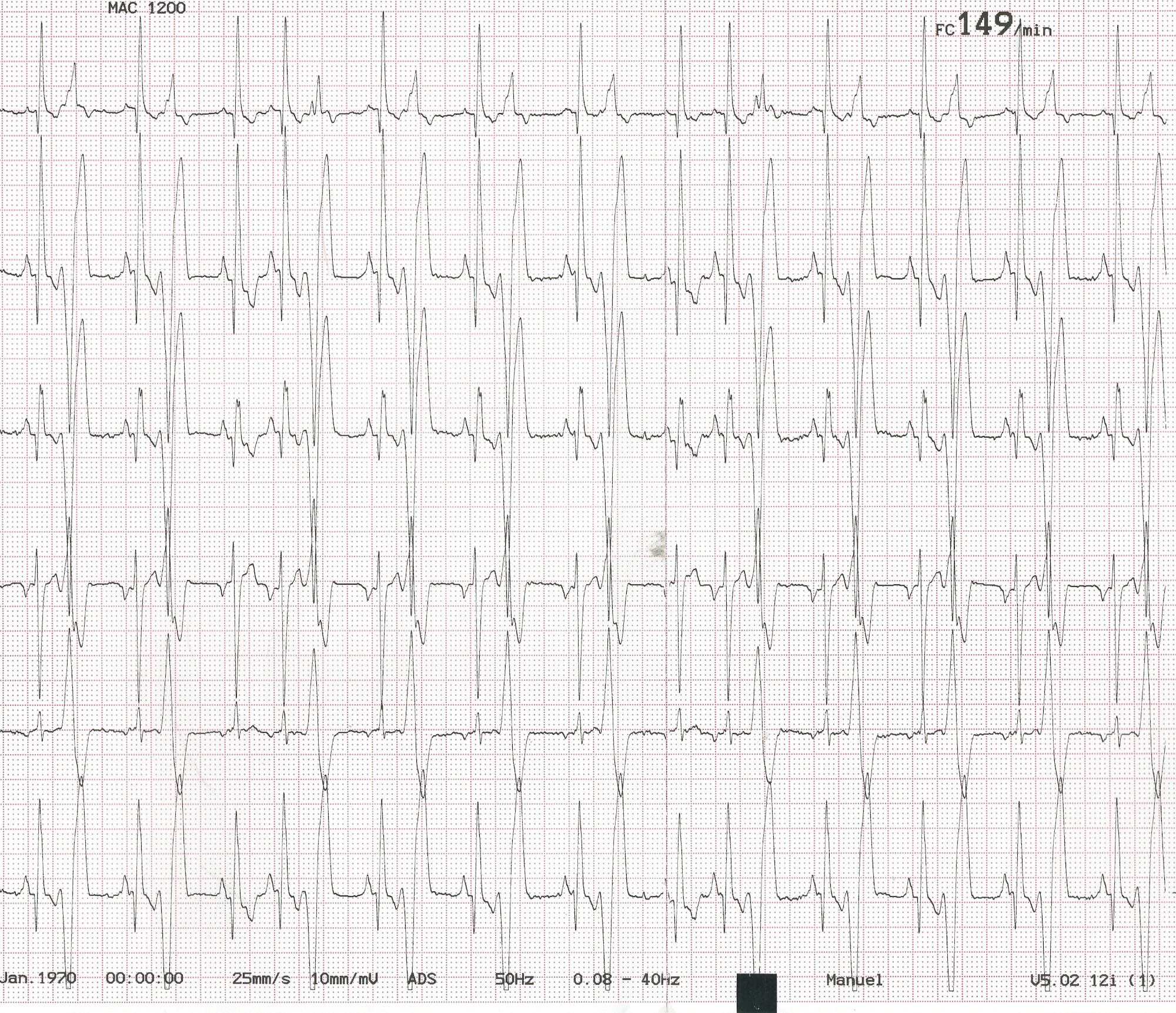 bigéminisme ventriculaire sur un doberman de 8 ans atteint de cardiomyopathie dilatée