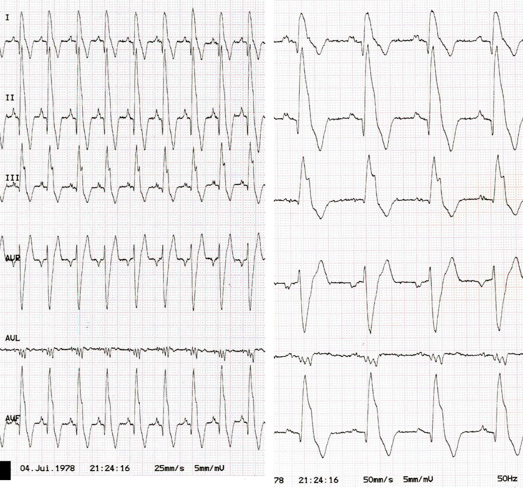  QRS hypervoltés de morphologie RR' et ondes P élargies dans une cardiomyopathie dilatée.