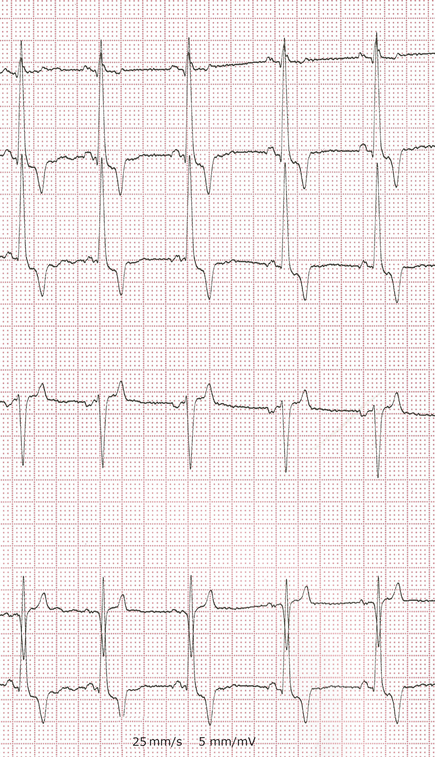 Bradycardie sinusale et dilatation cavitaires dans une cardiomyopathie dilatée.