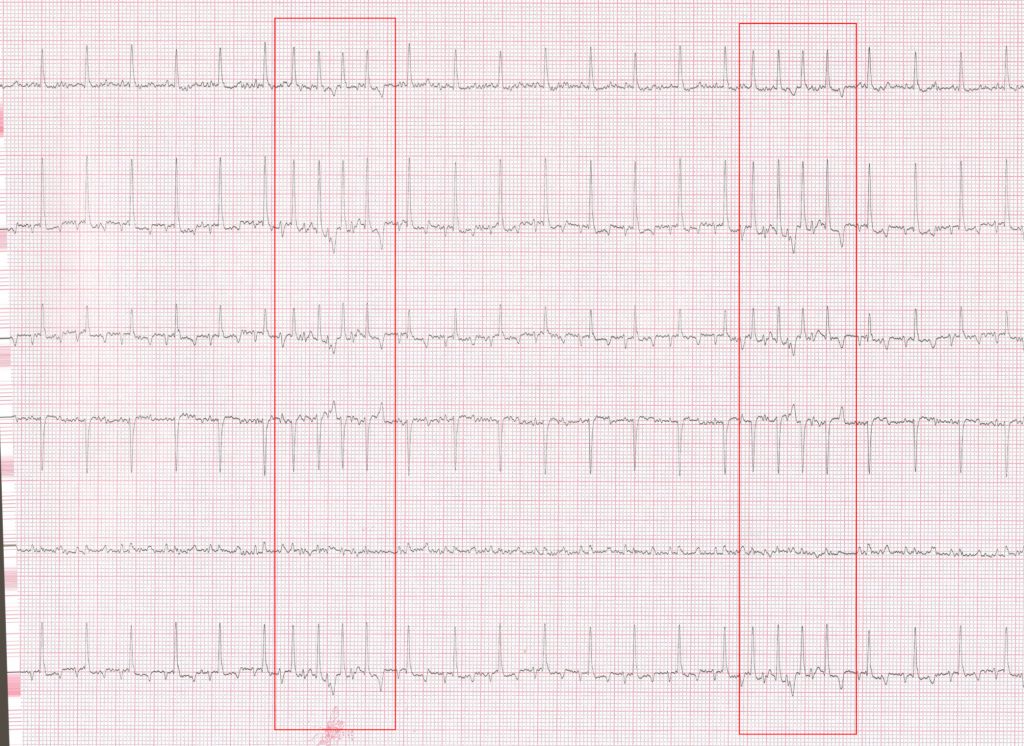 salves d'extrasystoles atriales au cours d'un rythme de sinus coronaire. (ondes P négatives en D2, D3 et AVF)