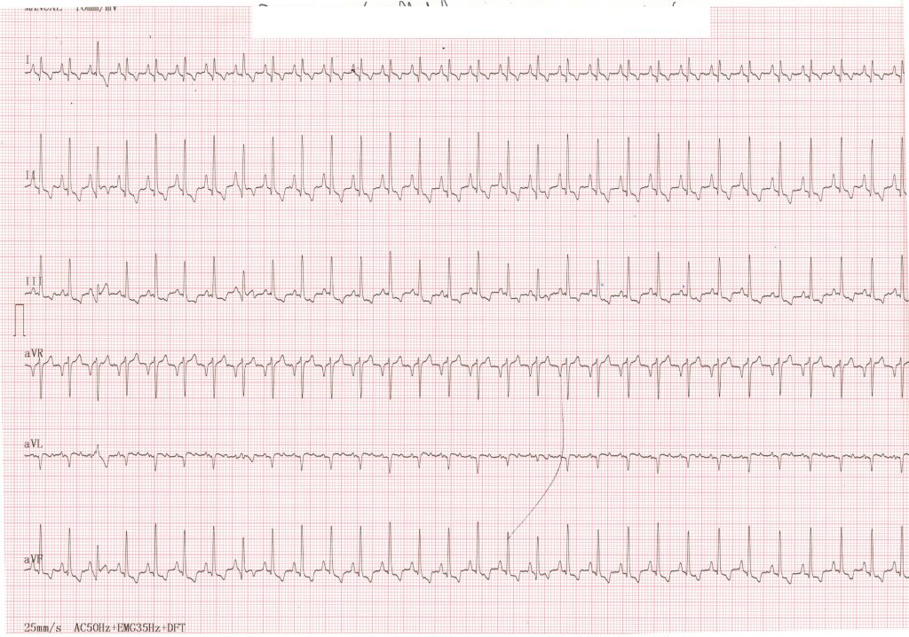 Rythme sinusal enregistré après cardioversion
