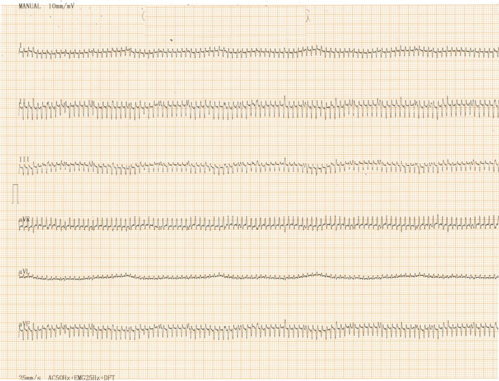 Tachycardie ventriculaire à 600 bpm chez un chat sans anomalie structurelle du myocarde.