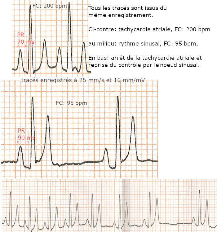 séquence P-QRS-T ectopique