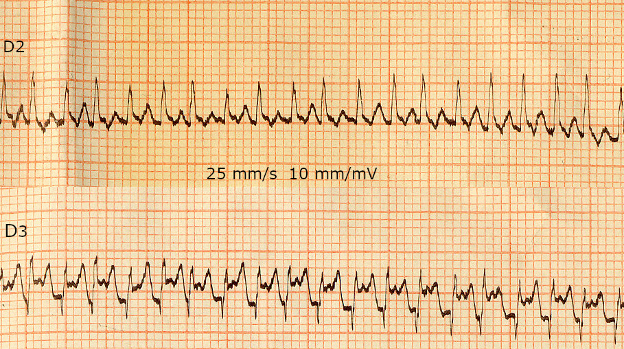 Tachycardie jonctionnelle orthodromique